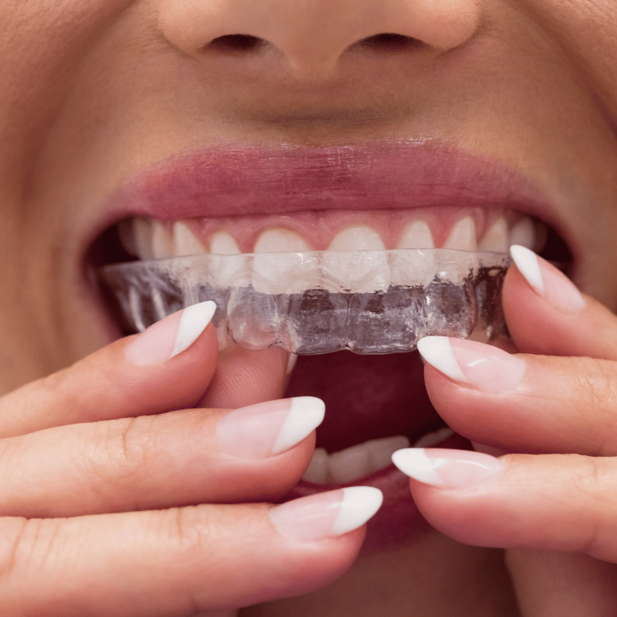 Invisalign in El Monte, CA - Angel Dental Care (6) Invisalign in El Monte, CA - Angel Dental Care
